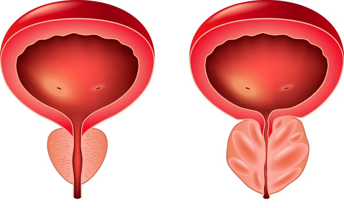 normāla un slima prostata